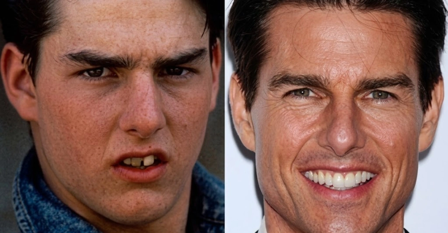 Celebrity Dental Implants Before and After5